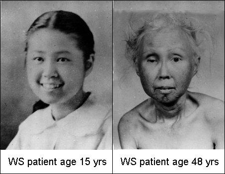 Subcutaneous calcification Premature arteriosclerosis Diabetes mellitus Cancer A wizened and prematurely aged facies.