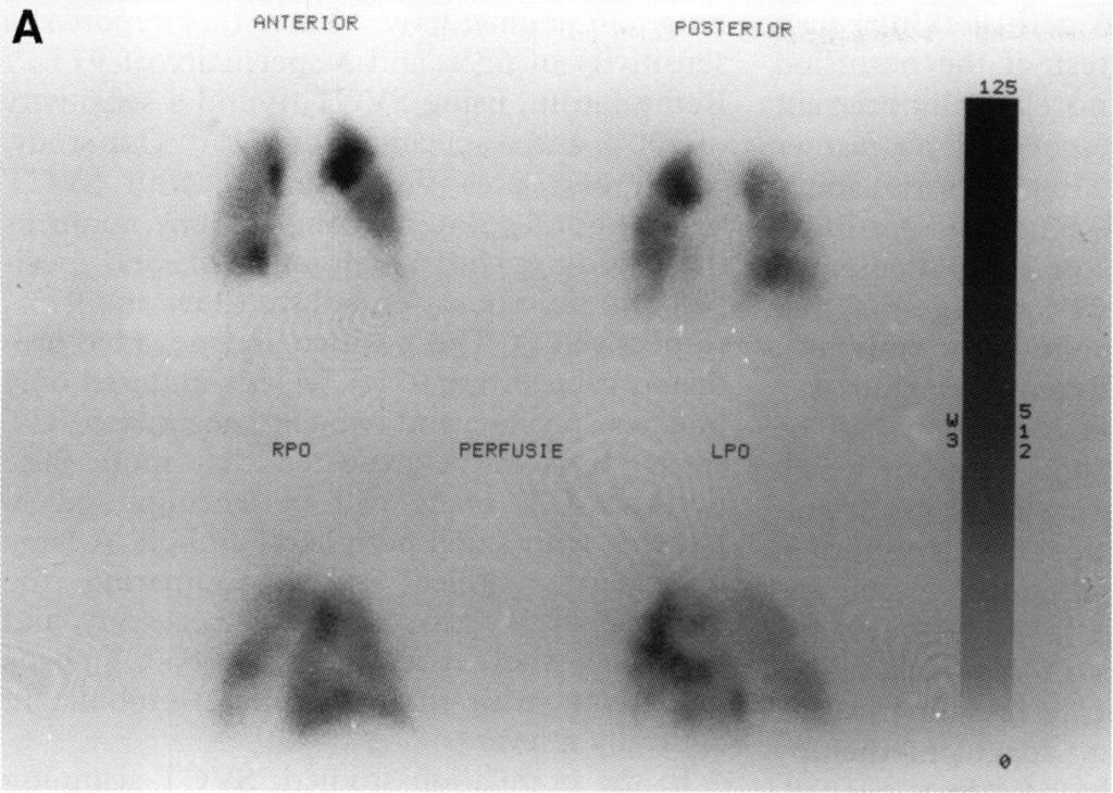 SVCT scanning in pulmonary embolism 27 A Figure 5 A 44 year old man with high probability VIQ scan.