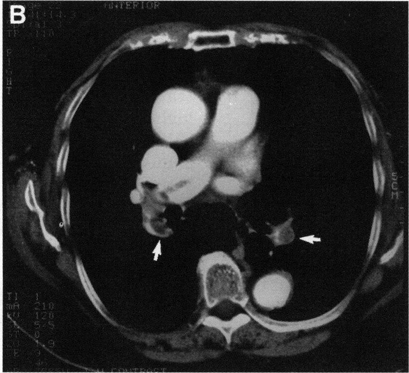 (B) SVCT scan showing large central emboli in both right and left pulmonary arteries (white arrows). embolism on SVCT.
