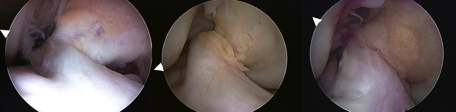 (AM, anteromedial; PL, posterolateral.) Figure 4.