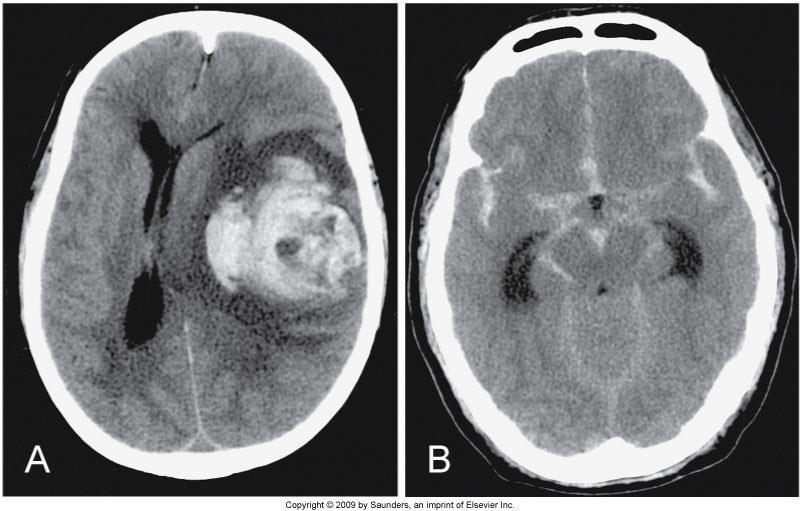 Hematoma Figure 17-2 A, Large left parenchymal hematoma causing a marked midline shift to