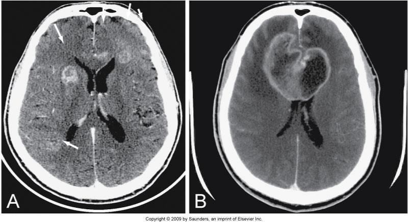 Metastasis Figure 17-4 A, Multiple ring enhancing metastases in both frontal lobes.