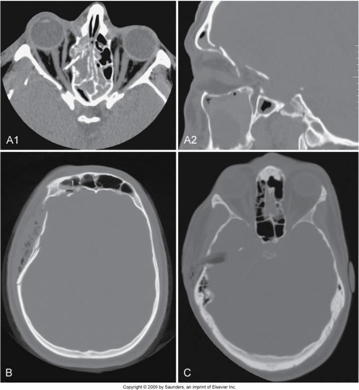 Trauma Figure 17-3 A, Orbital roof fractures; the transverse image on orbit settings shows the bone fragment spearing the right medial rectus muscle and the sagittal image on bone windows shows the