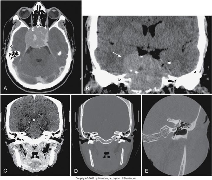 Pituitary and IACs Figure 17-7 A and B, Very large pituitary adenoma, filling the sphenoid sinus but not abutting on the optic chiasm, imaged in transverse plane and reformatted in coronal plane.