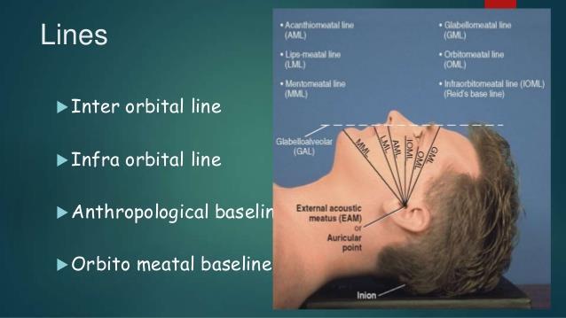 Scanning Protocols - Head IOML line Transverse plane Reformats - thin slices Direct coronals Sinuses (air-fluid levels) Temporal