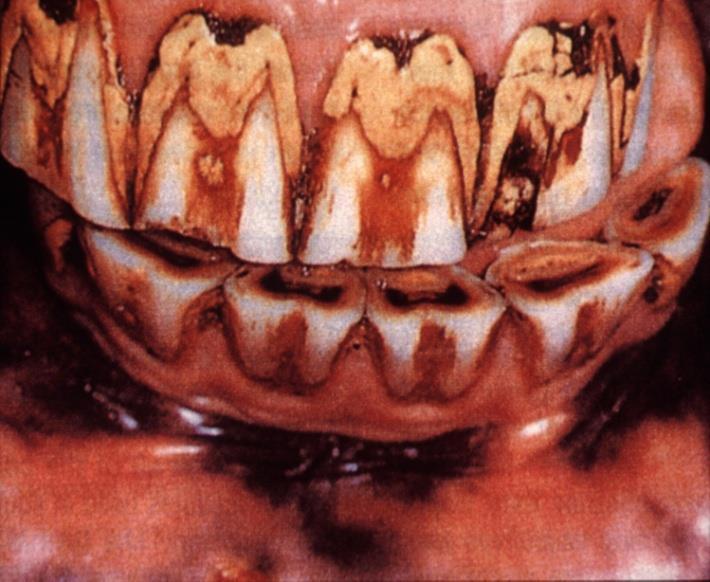 4. Periodontal disease Damage of gingiva & periodontal ligament