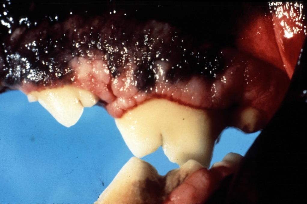 Pathogenesis Inflammation starts from gingival crevice Gingival recession &