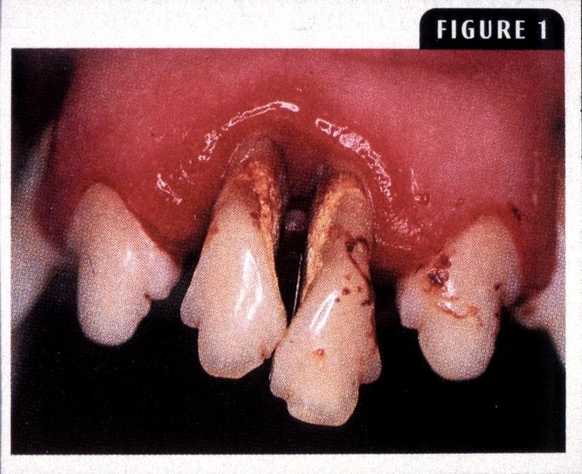 abscess Alveolar osteomyelitis Loss of tooth Bacteremia Early gingivitis at