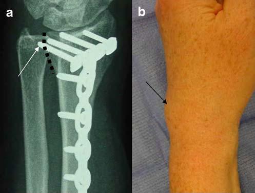 HAND (2007) 2:144 150 145 Figure 1 Sequelae of missed dorsal screw prominence: (a) 45 pronation view long ulnar most distal locking screw (arrow): (b) clinical photo: extensor tenosynovitis (arrow)