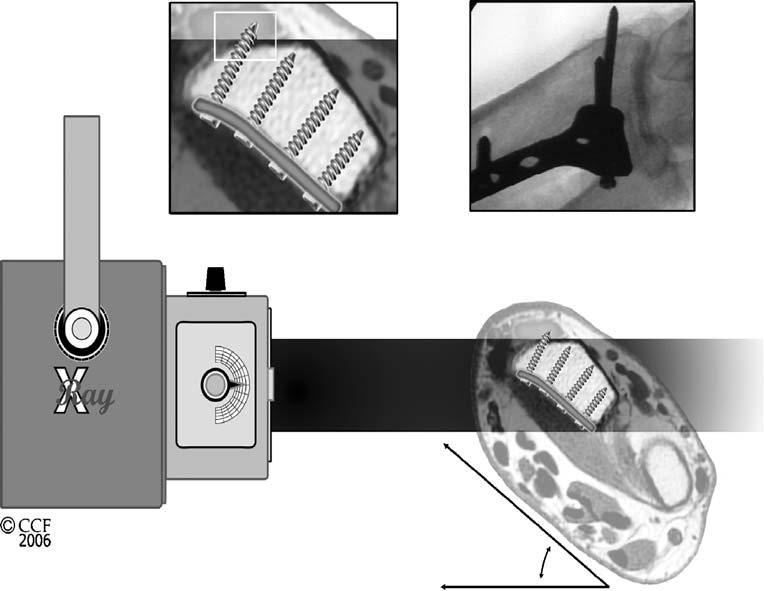 148 HAND (2007) 2:144 150 Figure 5 Cartoon depiction of the lateral radiographic projection when distal locking screw in position 1 is too long.