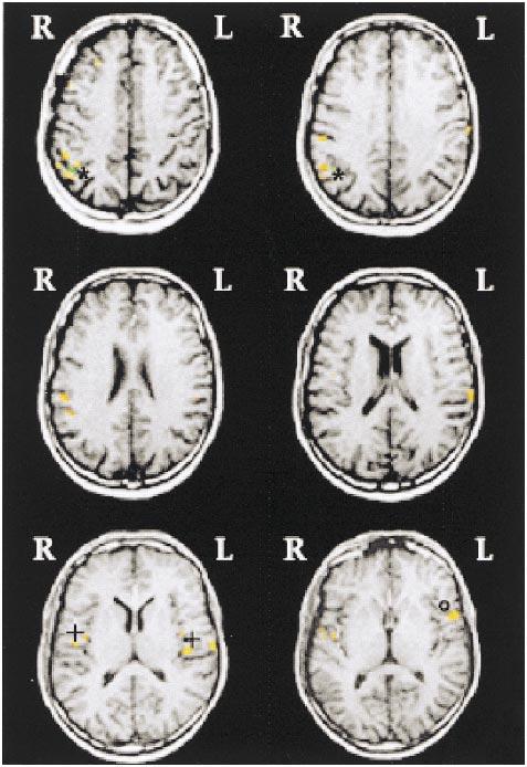 1404 CRÉAC H AJNR: 21, September 2000 Number of subjects with significant activation in specific structures Activated Structures Brodmann Area LH RH LH RH Prefrontal cortex BA 8, 9, 46 1 0 5 Primary