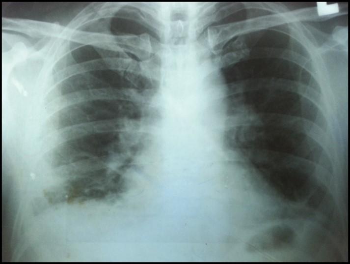 DISCUSSION Pulmonary Thrombo Embolism (PTE) is a major concern in health care with significant morbidity and mortality.