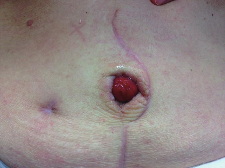 Translational Andrology and Urology, Vol 5, No 1 February 2016 139 Figure 3 Rose-bud anastomosis of cutaneous stoma after excision of the base of the umbilicus. a small cuff of cecum (14).