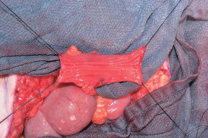 Additionally, note mesentery in the central 2 cm of the channel and denoted by the fat in both pictures.