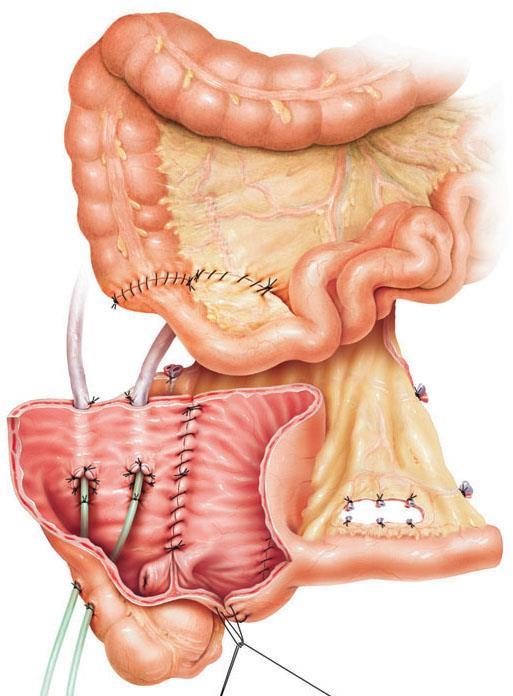 ileum and antireflux ureteral anastomoses *Illustrations