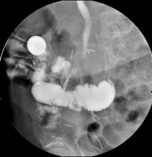 Urinary Diversions: Early Complications Bowel Anastomotic leaks and/or