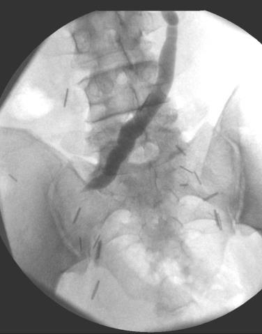 conduit stricture Can occur in