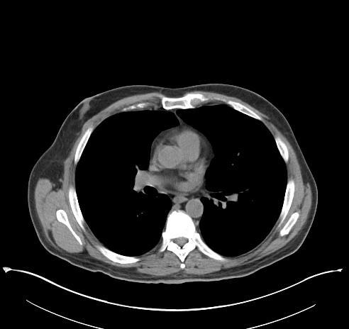 Parastomal Hernia in a Patient with Ileal Conduit 11 months after surgical relief of