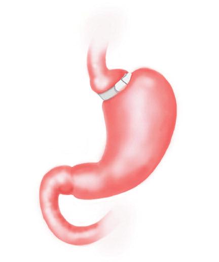 Conventional Bariatric/Metabolic Procedures Laparoscopic Adjustable Gastric Banding (LAGB) The LAGB is a restrictive procedure that involves encircling the upper part of the stomach with a band-like,