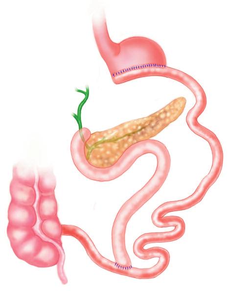 Conventional Bariatric/Metabolic Procedures Figure 1A Biliopancreatic Diversion (BPD) and BPD-DS The operation involves a gastric resection (usually leaving behind a 200-500 ml sized stomach) + a