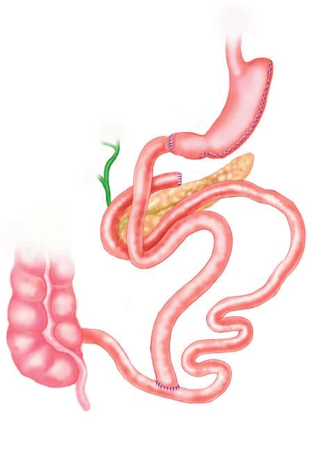 The remnant stomach is anastomosed to the distal 250 cm of small intestine (called alimentary limb).