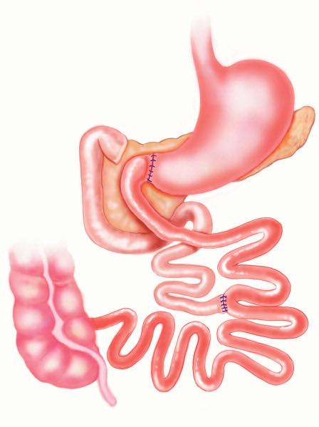 Investigational Gastrointestinal Procedures Figure 2A Duodenal-Jejunal Bypass (DJB) Originally described by Rubino as an experimental procedure to investigate mechanisms of action of gastric bypass