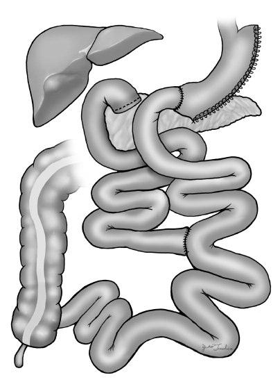 A variant of this procedure includes the association of proximal intestinal bypass with sleeve resection of the stomach (DJB-SG- Fig 2B) to reduce potential for marginal ulcerations and potentially