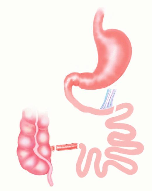 Investigational Gastrointestinal Procedures Ileal Interposition (IT) The concept of ileal-interposition was first described by Koopmans and Sclafani in rodents experiments as a weight loss procedure.