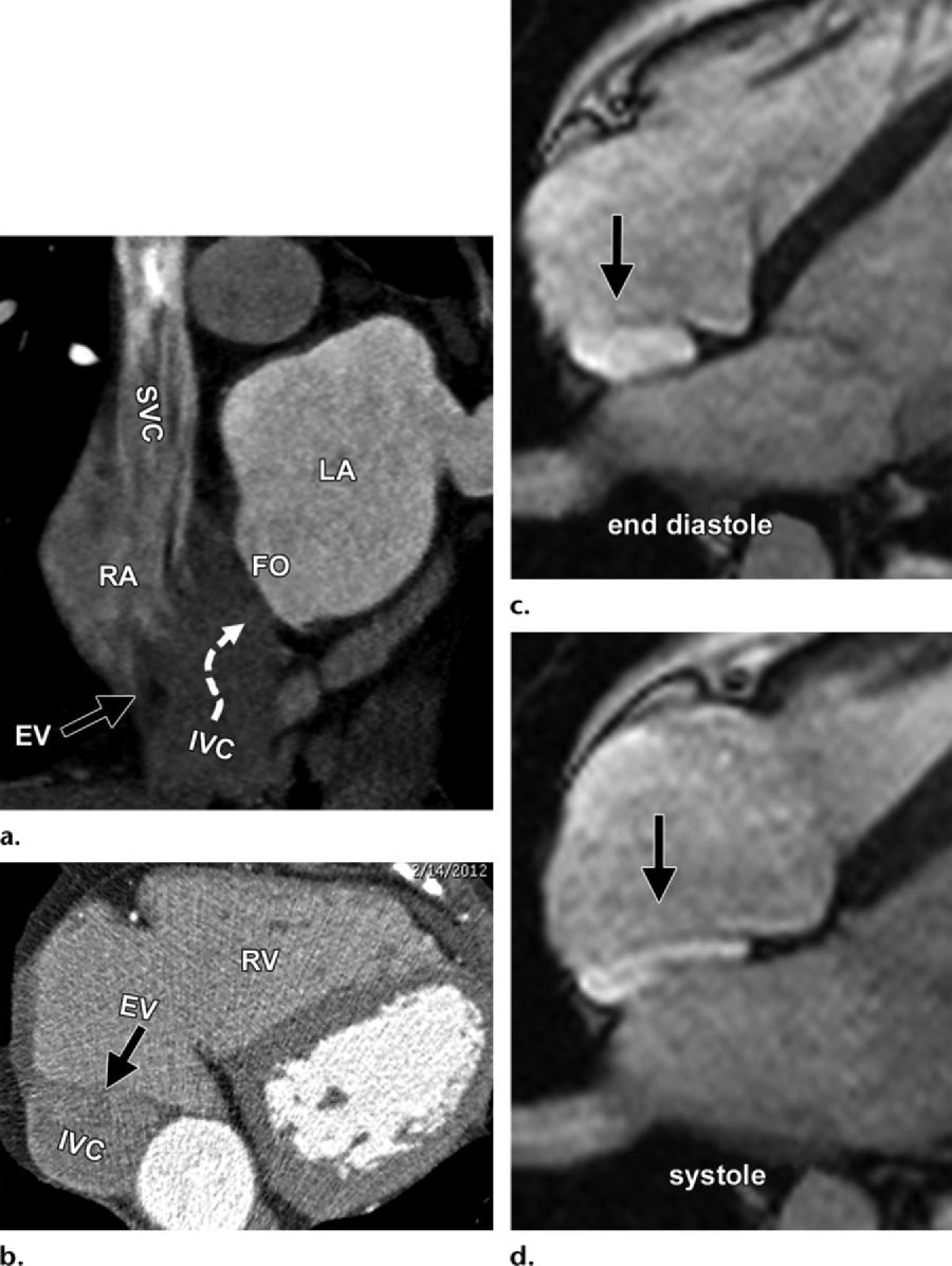 1578 October Special Issue 2014 radiographics.rsna.org Figure 4. IVC flow and the eustachian valve.