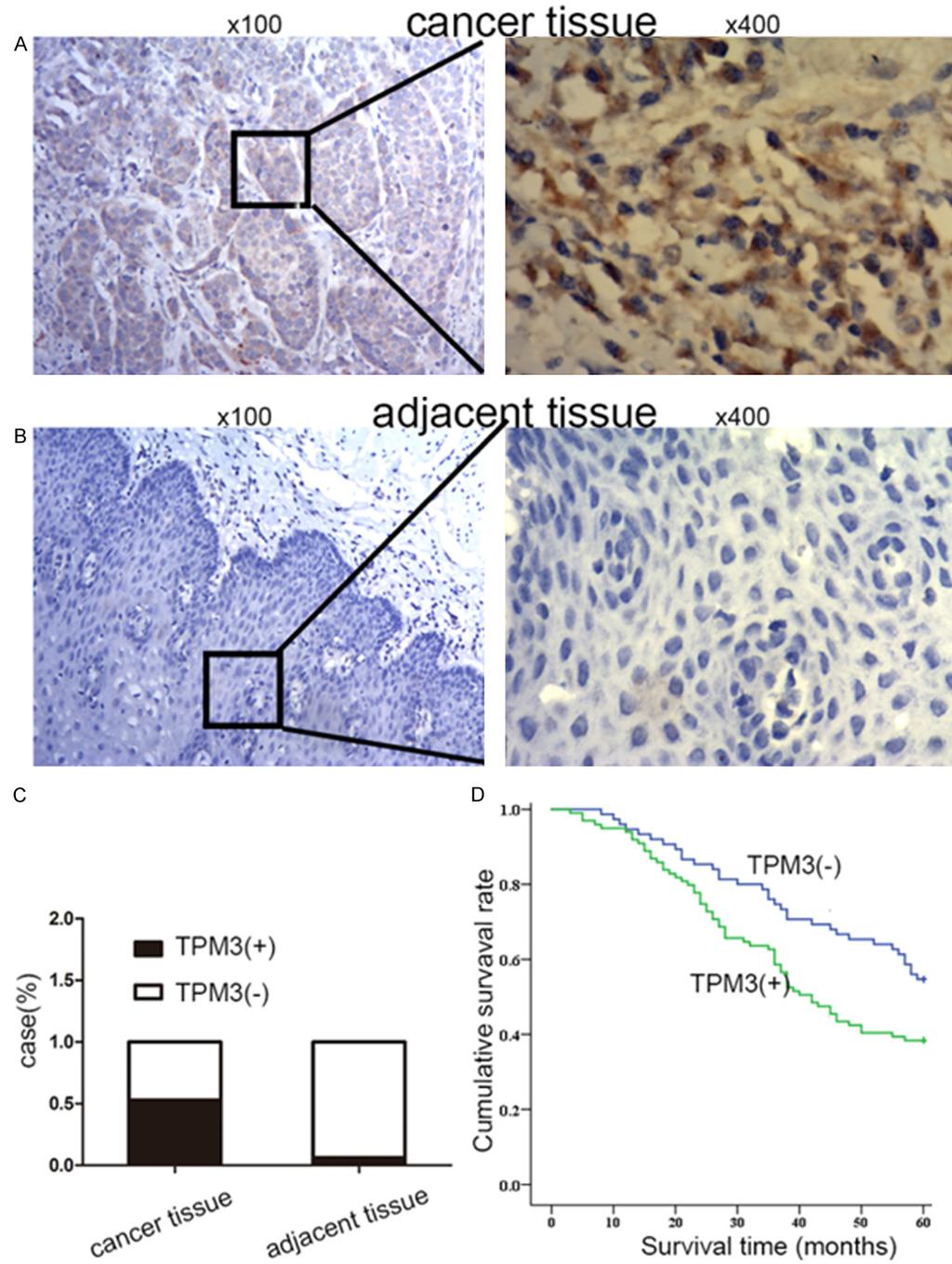 Figure 4. Analysis of TPM3 expression in esophageal cancer and adjacent tissues. A. Higher expression of TPM3 was observed with brown cytoplasm in the cancer tissue. B.