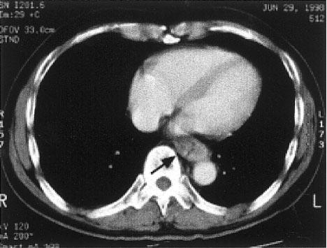 A B C D Fig. 4 A 61-year-old man with poorly differentiated squamous cell carcinoma in the lower thoracic esophagus who had a pathologically complete response after chemoradiotherapy.