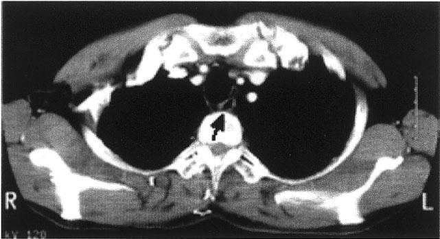 D, Post-chemoradiotherapy barium swallow showed an approximately 50%