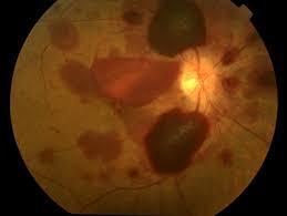 On ocular examination anterior segment was normal.