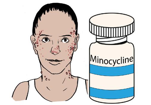 Dermatology (skin) Minocycline for acne About this medicine