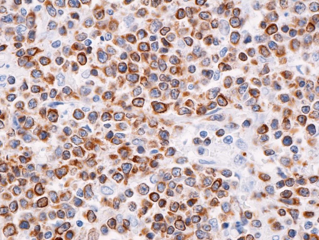 Diffuse large B-cell lymphoma.