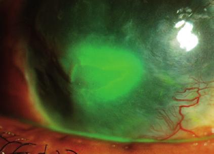 What happens when the cornea is injured?