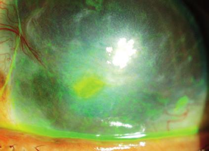 These are serious conditions which require diagnosis and treatment by an ophthalmologist specialising in, for example: