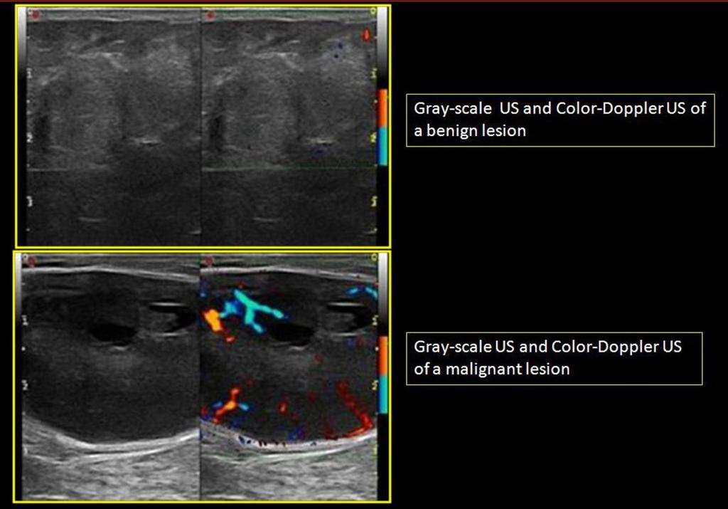 Fig. 3: Gray-scale US and Color-Doppler US