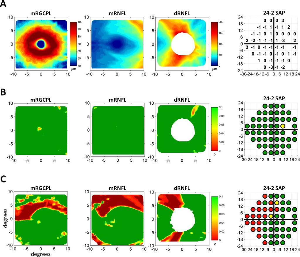 Improving Glaucoma Detection by Combining SAP and OCT IOVS j January 2014 j Vol. 55 j No. 1 j 615 FIGURE 2. Measurements from fdoct and SAP converted to probability values.