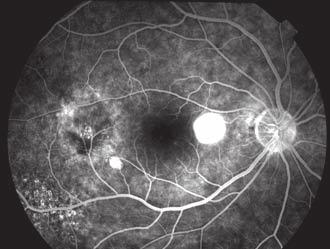 While most cases spontaneously resolve within 2 to 3 months, prolonged pigment epithelial detachment or subretinal fluid may lead to permanent visual-acuity loss and visual disturbances.