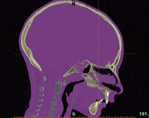 Preoperative Planning Preoperative planning Determine the postdistraction anatomic goal by conducting an evaluation of the craniofacial pathology and asymmetry through clinical exam, CT scan,