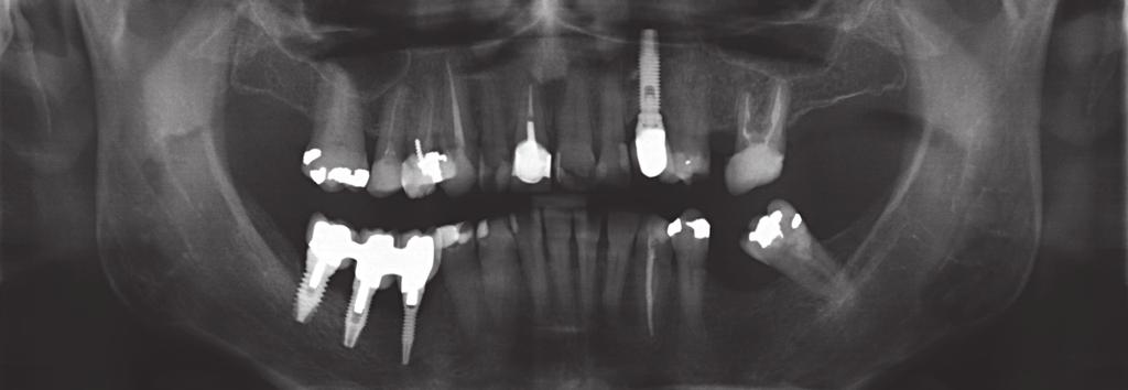 implant placement.