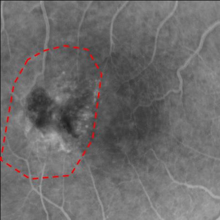 Macular Telangiectasia 2 Red dashed lines