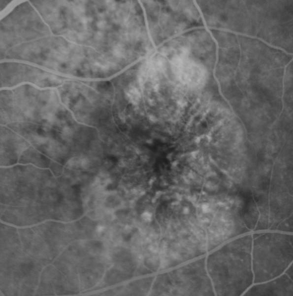 A New Approach to Protecting Vision AngioVue OCT Angiography brings valuable new information to clinical practice. Non-invasive visualization of retinal vasculature.