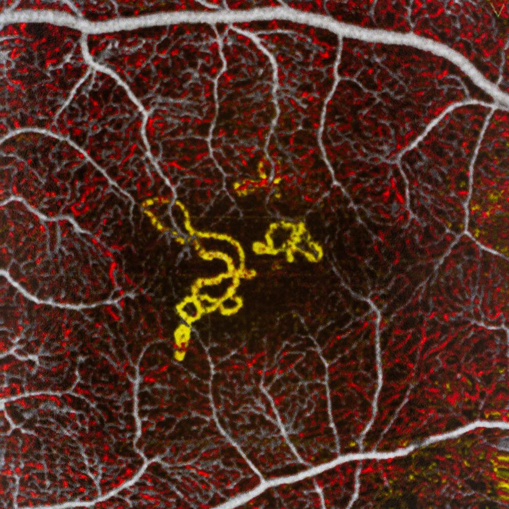 Outer Retina and Choriocapillaris Function Abnormal vasculature of Type II CNV is