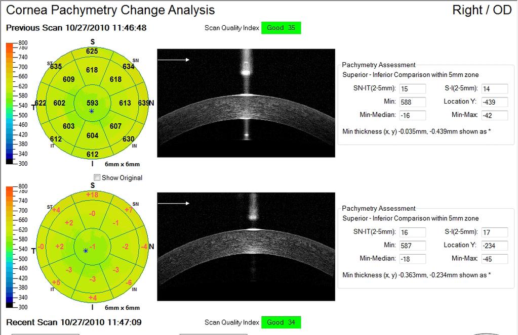 Cornea Angles OU Report Pachymetry Change Analysis
