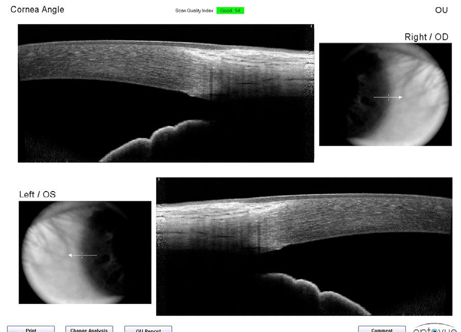 quantification of the corneal power by measuring