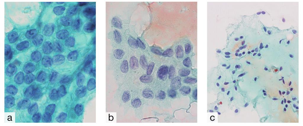 2 Colloids of NIFTP exhibited lumps of various sizes (a: large; b: medium; and c: small). (Papanicolaou stain; a: 40 ; b: 40 ; c: 200 ). Fig.