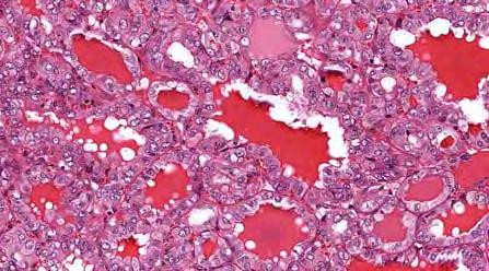 Non-invasive Follicular Thyroid Neoplasm with Papillary-like Nuclei