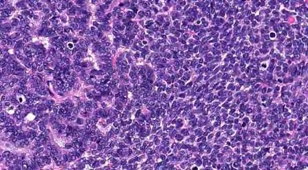Excluded: >3 mitoses/10 HPFs Excluded: Solid Pattern 67 68